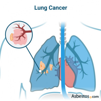 癌症在肺内的气囊上形成。