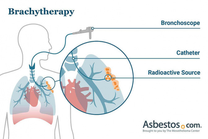 胸膜间皮瘤的近距离放射治疗