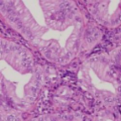 腺间皮瘤细胞