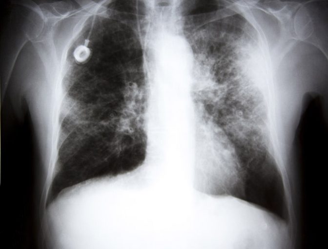 肺癌的x射线