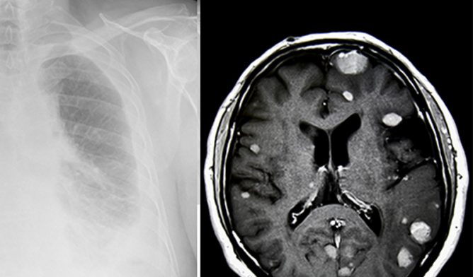 肺癌和脑肿瘤中的间皮瘤