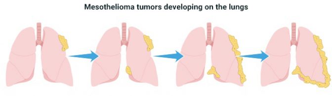 肺间皮瘤形成的四个阶段