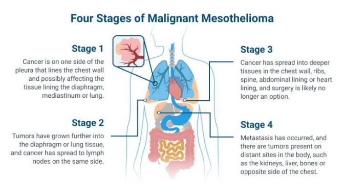 间皮瘤的4个阶段