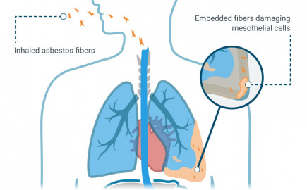 石棉纤维嵌入肺间皮后形成的间皮瘤