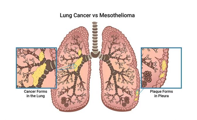 图示肺内膜恶性间皮瘤斑块与癌性肿瘤的对比