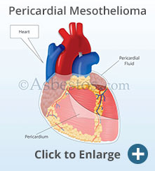 图示心包间皮瘤影响心脏