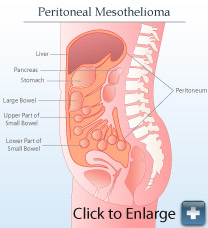 腹膜间皮瘤图