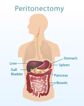 图示腹膜切除术或减细胞手术中涉及的六个器官