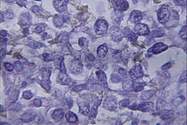 间皮瘤组织的细胞学污染