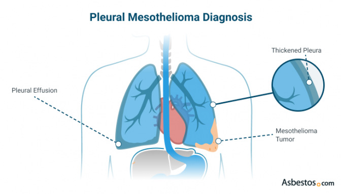 胸膜间皮瘤的迹象可以帮助诊断，包括胸膜增稠和胸腔积液