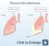 健康的肺与有间皮瘤的肺图