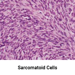 SarcomaToid Mesothelioma.