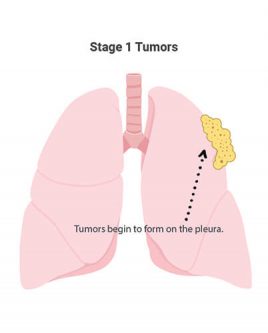 1期间皮瘤肿瘤进展