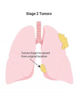2阶段间皮瘤