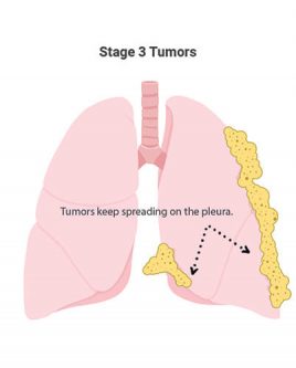 第三阶段间皮瘤