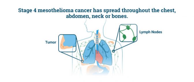 4阶段4间皮瘤肿瘤从肺部蔓延到其他重要器官